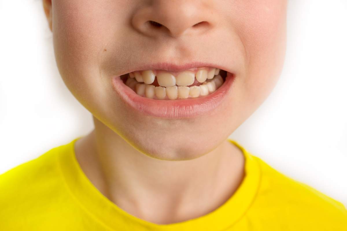 malocclusione bambino: conseguenze