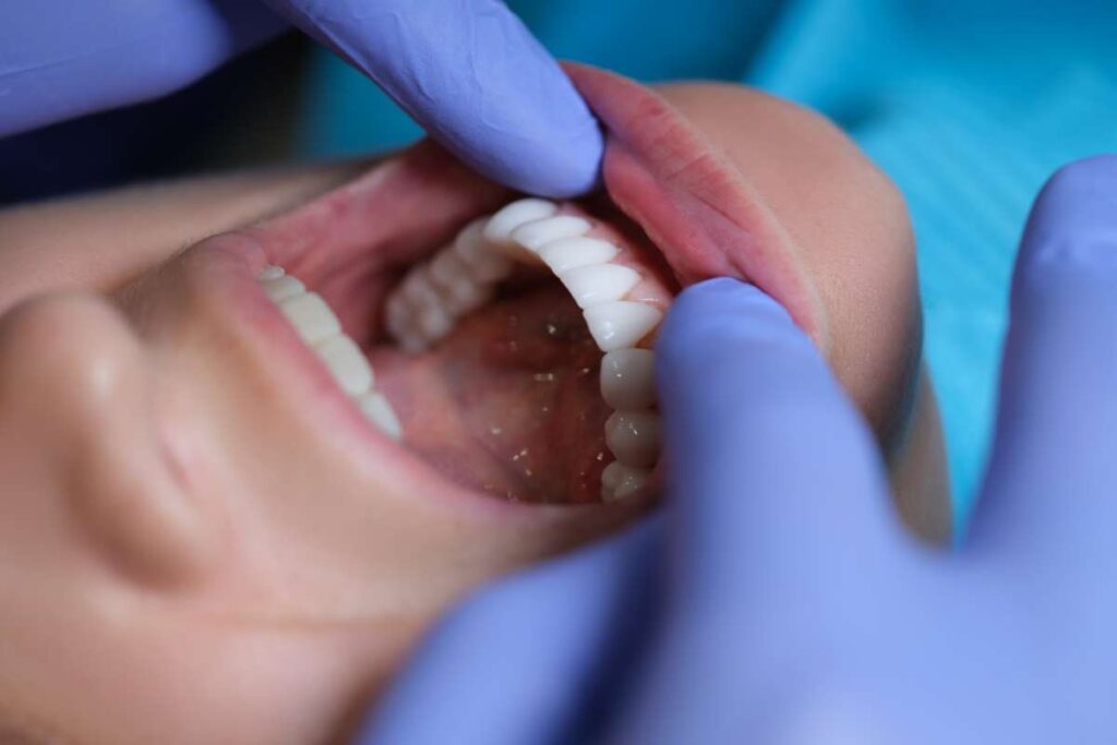 faccette dentali denti larghi