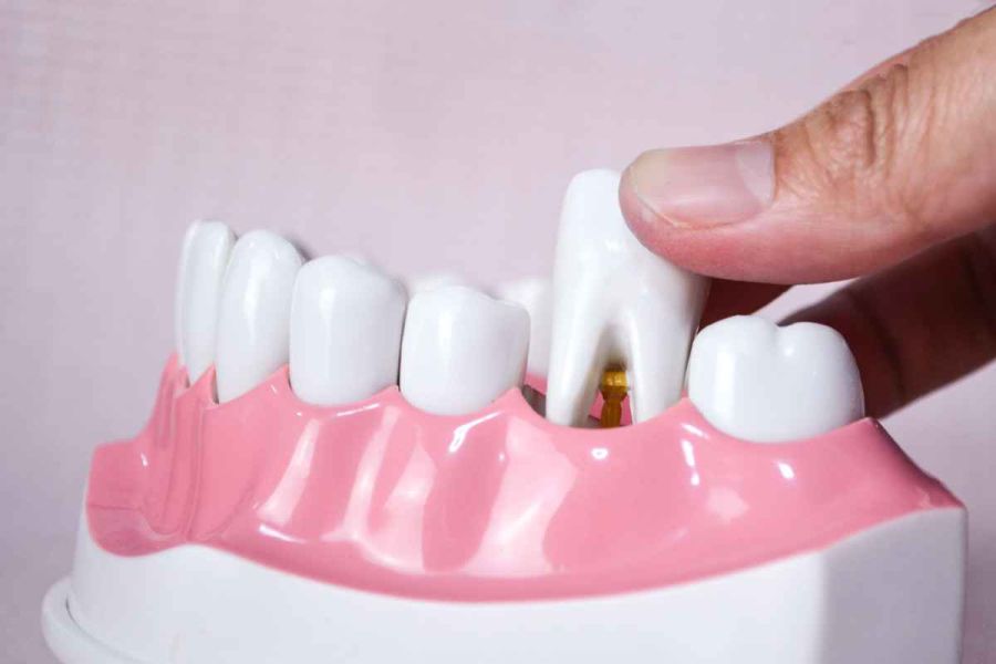 estrazione dentale guida: scopri tutto sull'estrazione dentaria