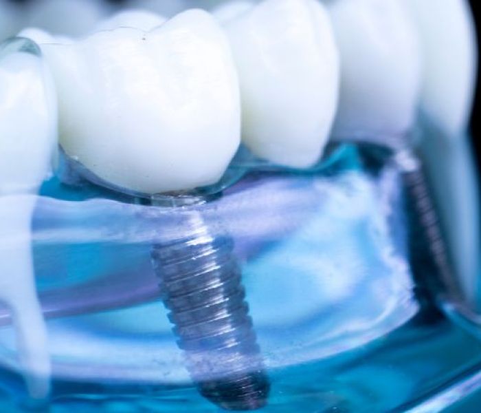 implantologia a roma
