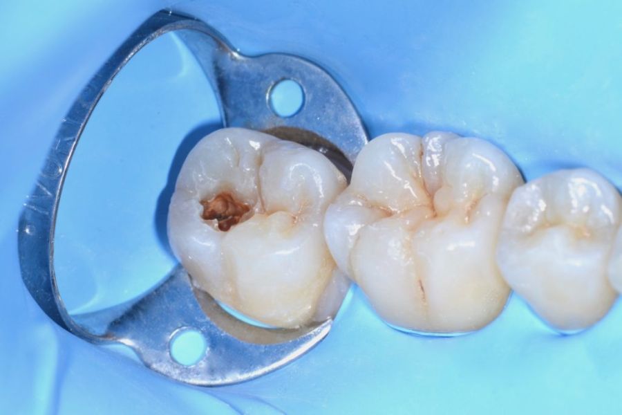 dente con carie odontoiatria conservativa