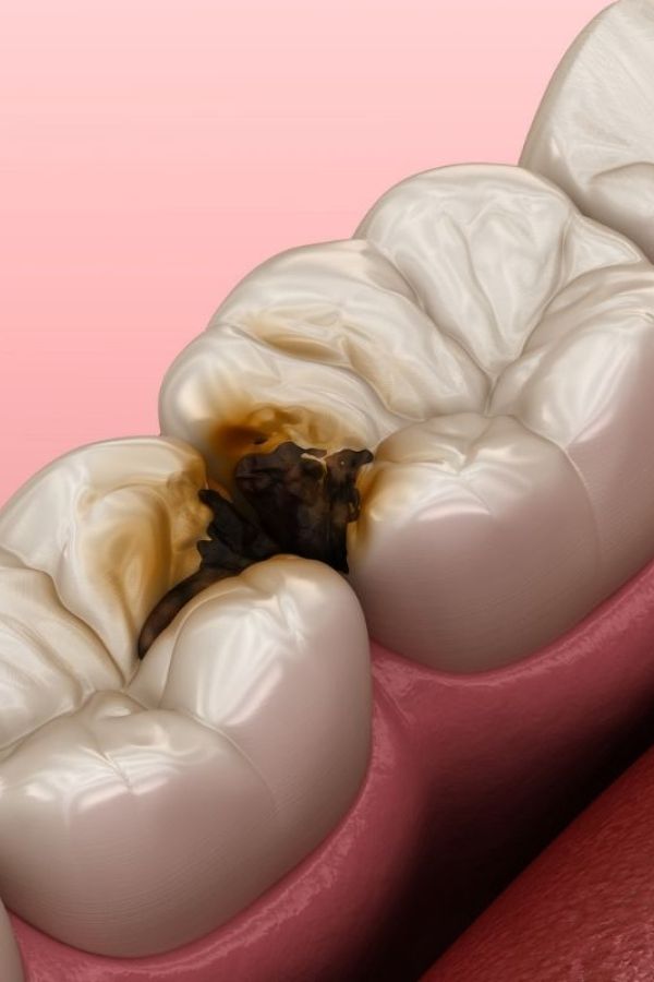 carie dentale, trattamento per carie a roma